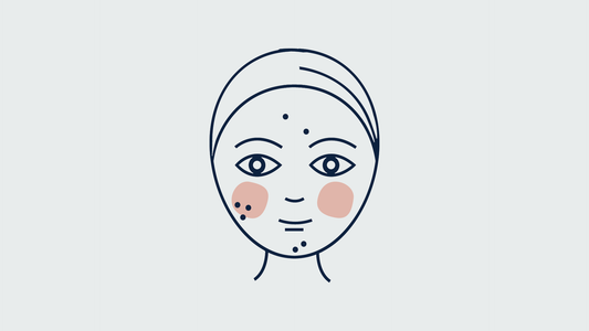 persona con acné en el rostro y dos manchas rosadas en los pómulos
